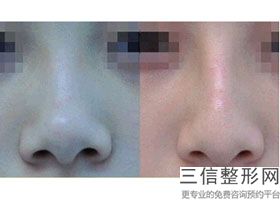 黑龙江省隆鼻整形医院排名榜top5权威评点,哈尔滨隆鼻整形整容医院