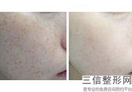 衡阳做热玛吉官方授权医院排名前五汇总,湘雅医院有热玛吉吗