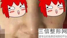 呼和浩特隆鼻医院排名前五新版公布,隆鼻公立医院哪家好
