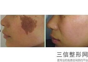 呼和浩特热玛吉官方授权医院排行榜详情公布,热玛吉 协和医院