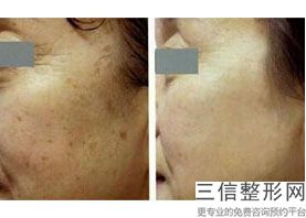 呼和浩特做热玛吉正规医院有哪些,北京哪家公立医院做热玛吉