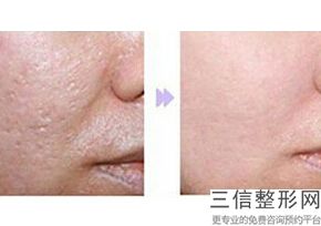 呼和浩特做热玛吉正规医院有哪些,北京哪家公立医院做热玛吉