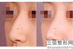 湖北省隆鼻医院排名前五强名单发布,武汉隆鼻良好的医院