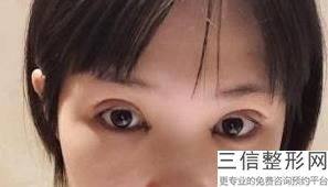 湖南长沙修复双眼皮医生排名前五,长沙修复双眼皮的专家