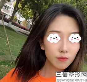 湖南省隆鼻医院排名前五榜单推荐,湖南良好的鼻整形医生