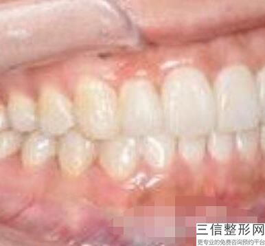 湖南牙齿矫正医院排名榜top5一文速览,长沙县牙齿矫正比较好的牙科医院