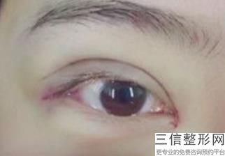 湖南眼部整形专家排行榜前五名单汇总,中国眼部整形专家排行榜