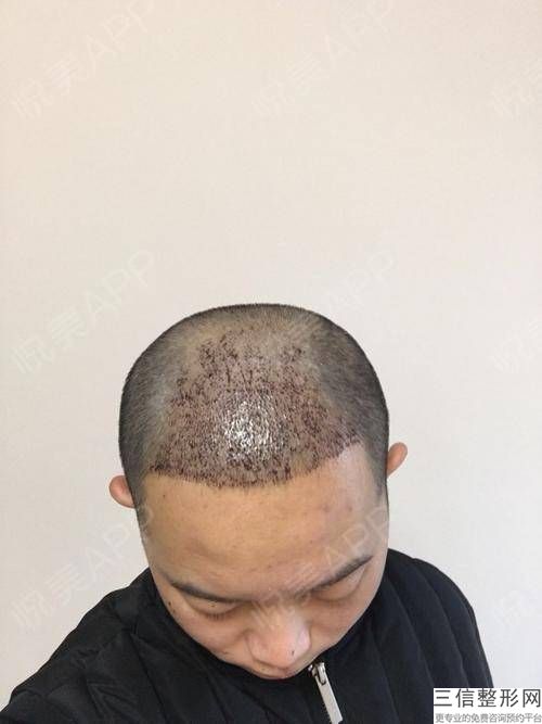 湖南植发医院排名榜前八强名单发布,湖南良好的植发医院哪家良好