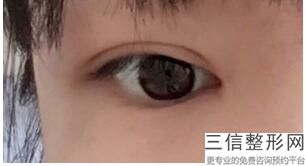 湖南做双眼皮整形医院前五盘点,长沙哪家整形医院做双眼皮好