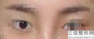 湖南做双眼皮整形医院前五盘点,长沙哪家整形医院做双眼皮好