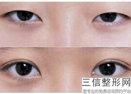 湖南做双眼皮整形医院前五盘点,长沙哪家整形医院做双眼皮好
