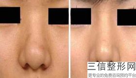 湖州比较好的肋骨隆鼻整形机构都有哪些,湖州哪家整形医院好