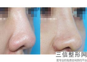 华美做鼻子好的医生有哪些,华美整形做鼻子的医生