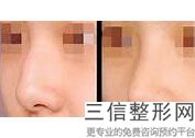 隆鼻后要到沈阳奉天整形医院价格表一份,沈阳做隆鼻好的医院