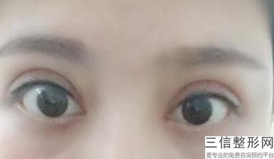 绵阳割双眼皮正规医院有哪些,绵阳做双眼皮自然选哪家