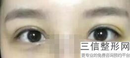 牡丹江双眼皮修复好的医院排名榜,牡丹江哪里做双眼皮好