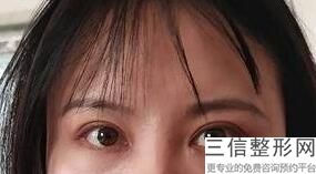 南昌割双眼皮整形医院排行榜,南昌割双眼皮哪里比较好