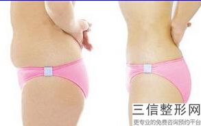 南昌面部抽脂好的医院排名表上线,南昌大腿吸脂哪里好