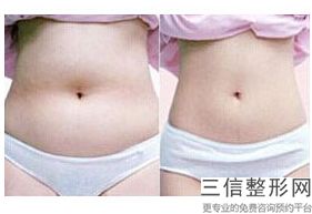 南昌面部抽脂好的医院排名表上线,南昌大腿吸脂哪里好