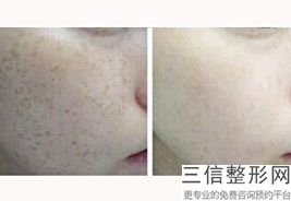 南昌热玛吉正规医院官方授权排行榜公布,南昌哪家医院有热玛吉的授权