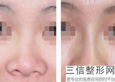 南京隆鼻医院排名榜前五强好评推荐,南京鼻子整形良好的三甲医院