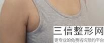 南京隆胸修复医院哪家好,南京哪家隆胸医院比较专业
