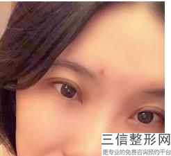 南京哪家公立整形医院做双眼皮修复好,南京割双眼皮好的医院
