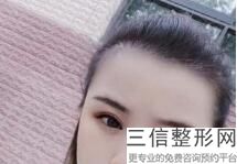 南京哪家公立整形医院做双眼皮修复好,南京割双眼皮好的医院