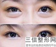 南京哪家公立整形医院做双眼皮修复好,南京割双眼皮好的医院