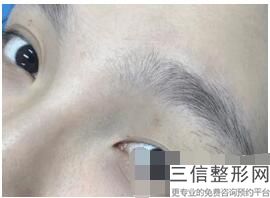 南京哪家公立整形医院做双眼皮修复好,南京割双眼皮好的医院