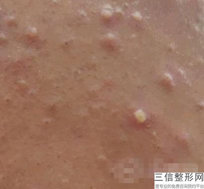 南京热玛吉五代官方授权医院排名榜,北京热玛吉五代授权医院