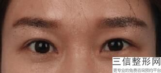 南京双眼皮整形医院排名前四年度翻盘,南京割双眼皮比较出名的整形医院