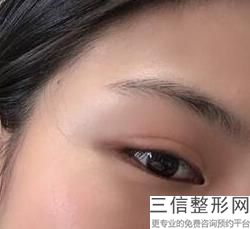 南京双眼皮整形医院排名前四年度翻盘,南京割双眼皮比较出名的整形医院