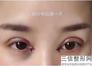 南京整形医院做全切双眼皮口碑排行榜,南京哪个医院割双眼皮好