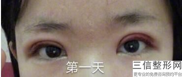南京整形医院做双眼皮口碑排名前四发布,南京医院做双眼皮良好