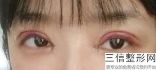 南京正规治眼袋医院排行榜内精选3家,南京切眼袋好的医院