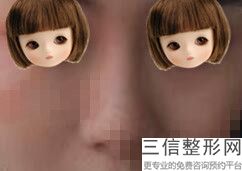 南京自体隆鼻整形医院排名前十权威汇总查询,南京哪家医院隆鼻好
