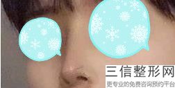 南京自体隆鼻整形医院排名前十权威汇总查询,南京哪家医院隆鼻好