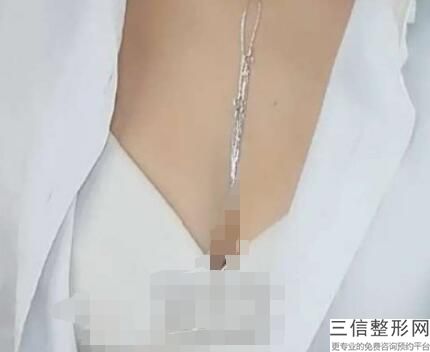 南宁隆胸好的十大整形医院排名榜,南宁隆胸整形哪家医院好
