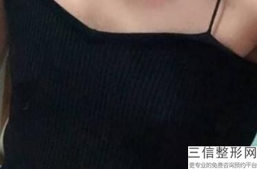 南宁做隆胸整形医院排名榜请签收,南宁整形隆胸手术医院