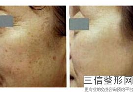 南通热玛吉授权认证医院有哪些,南通热玛吉官网认证机构