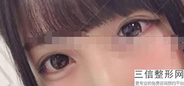 南阳割双眼皮整形医院排名前八权威甄选,南阳市割双眼皮