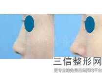 南阳公立隆胸医院排行榜,南阳隆鼻哪家医院良好