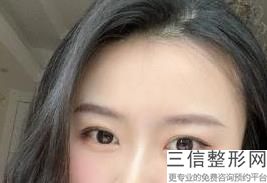 内蒙古割双眼皮医生排名榜前五,辽宁做双眼皮良好的医生