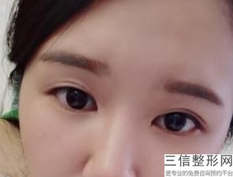 内蒙古割双眼皮医生排名榜前五,辽宁做双眼皮良好的医生