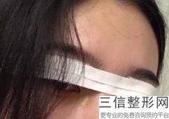 内蒙古割双眼皮医生排名榜前五,辽宁做双眼皮良好的医生