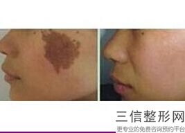 你的长沙热玛吉整形医院排名榜前十已送达,长沙做热玛吉五代授权医院前五名单