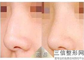 年杭州萧山隆鼻整形医院排名大公开,萧山整形科哪个医院好