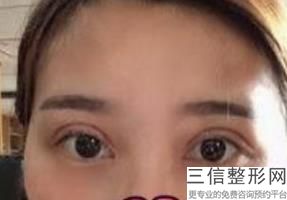年湖州去眼袋整形医院排名前十,三甲美容整形去眼袋医院排名