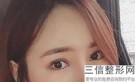 年南京比较好的双眼皮整形机构排名大公开,南京三甲医院整形双眼皮排行